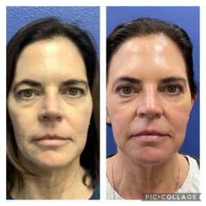 Upper Blepharoplasty Case Results