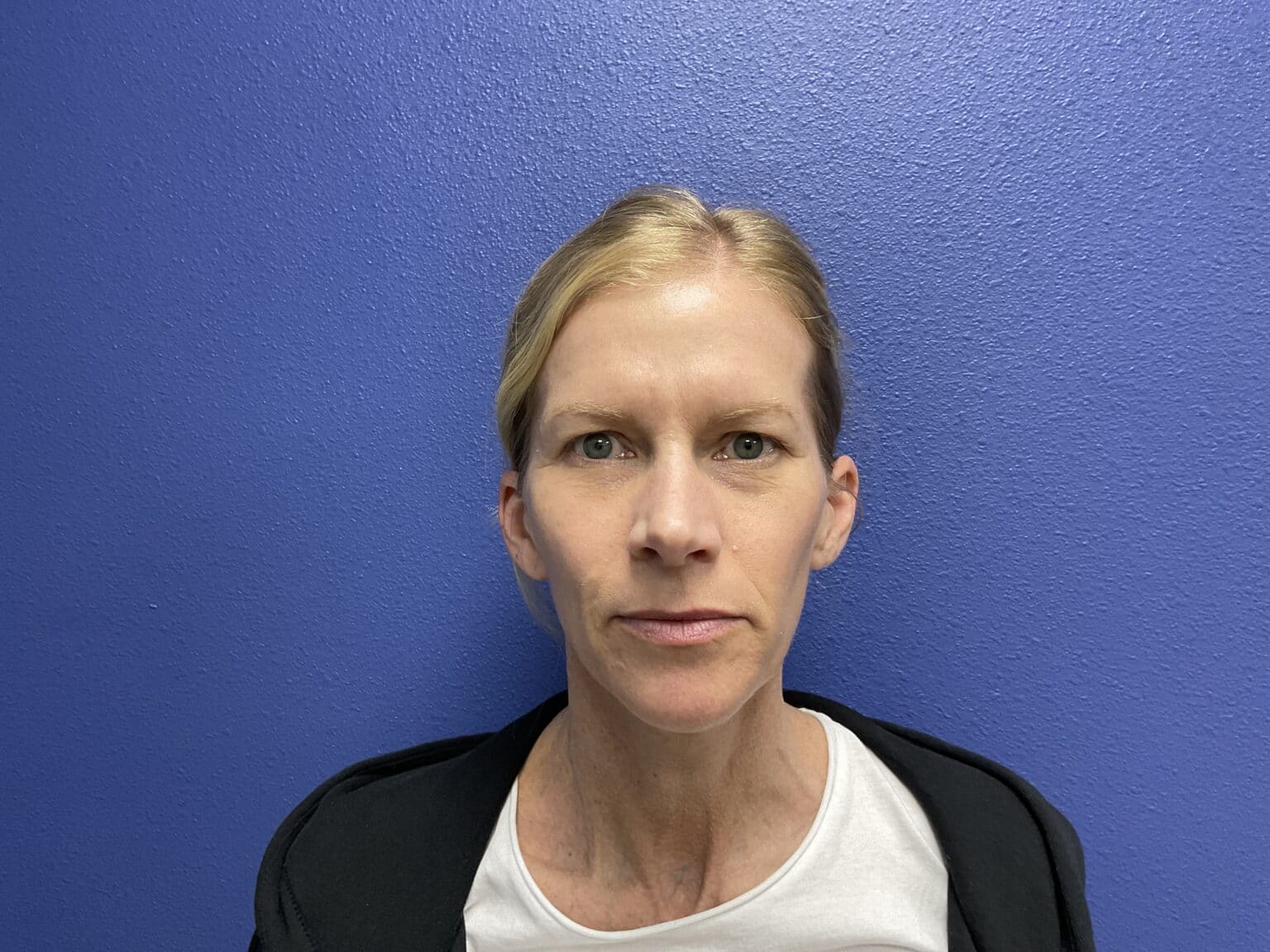 Upper Blepharoplasty Case Results