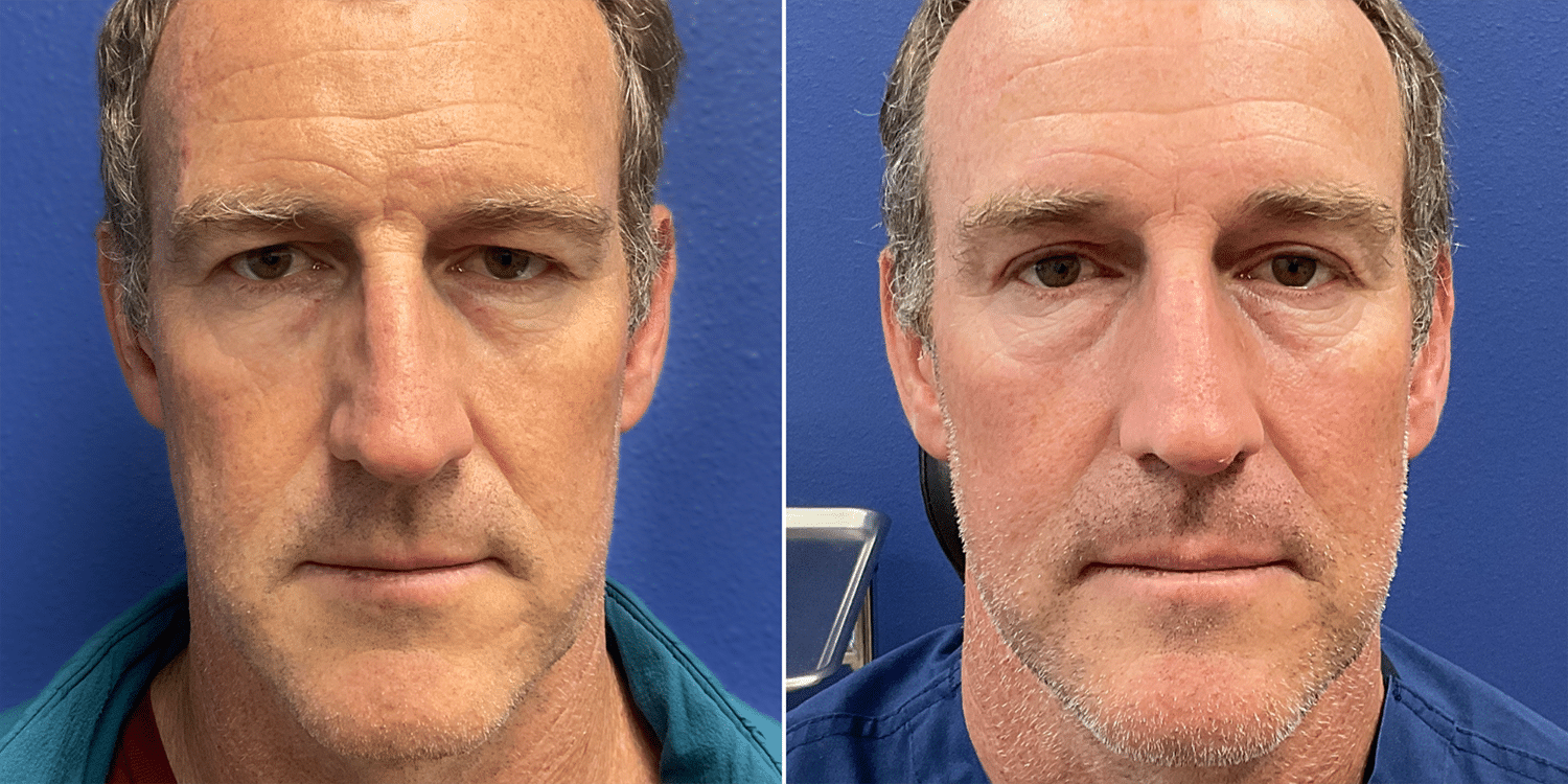 Upper Blepharoplasty Case Results