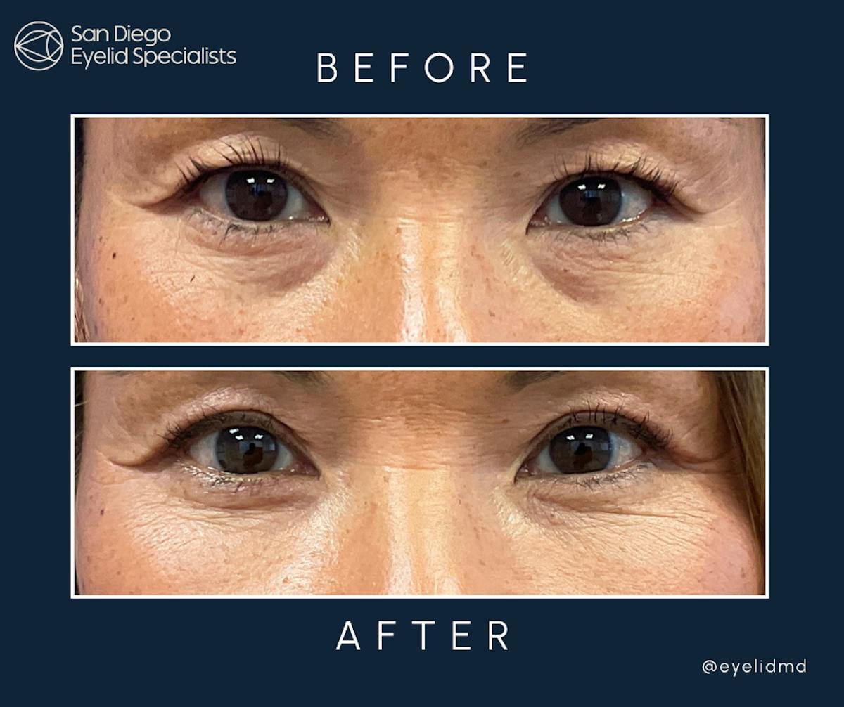 Lower Blepharoplasty Before & After Gallery - Patient 118609 - Image 1