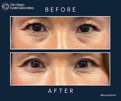 Lower Blepharoplasty Before & After Gallery - Patient 118609 - Image 1