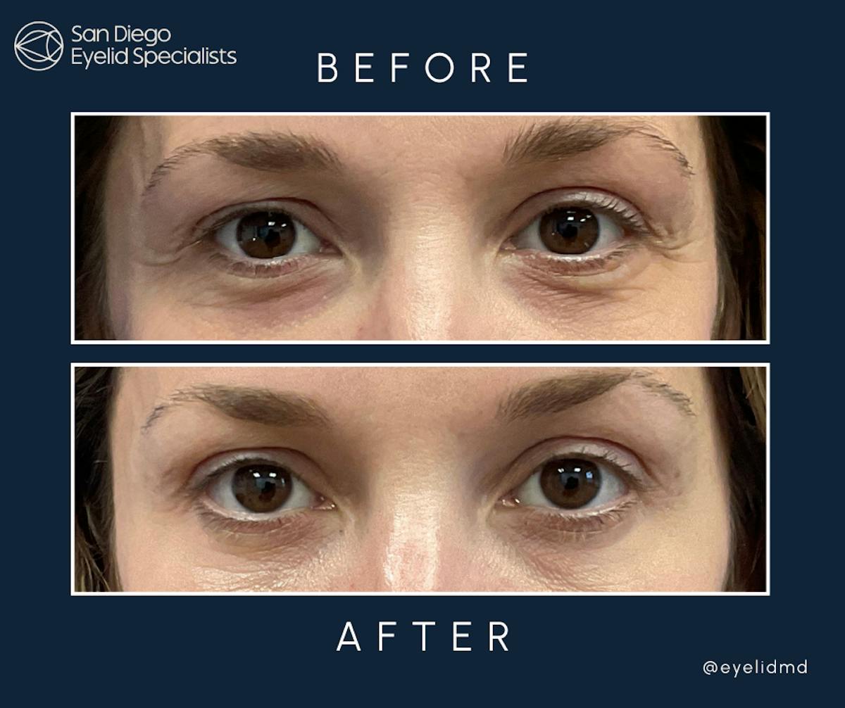 Lower Blepharoplasty Before & After Gallery - Patient 329911 - Image 1