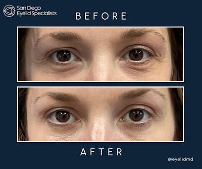 Lower Blepharoplasty Before & After Gallery - Patient 329911 - Image 1