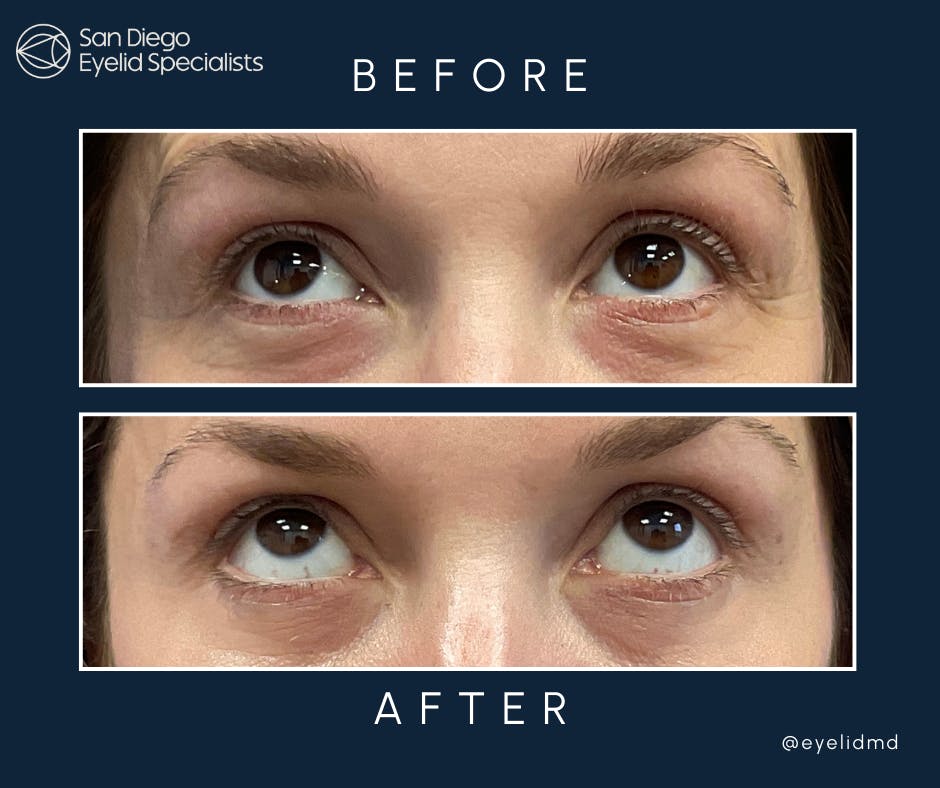 Cosmetic Lower Eyelid Surgery Before & After Gallery - Patient 329911 - Image 2