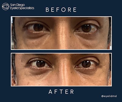 Lower Blepharoplasty Before & After Gallery - Patient 177551 - Image 1