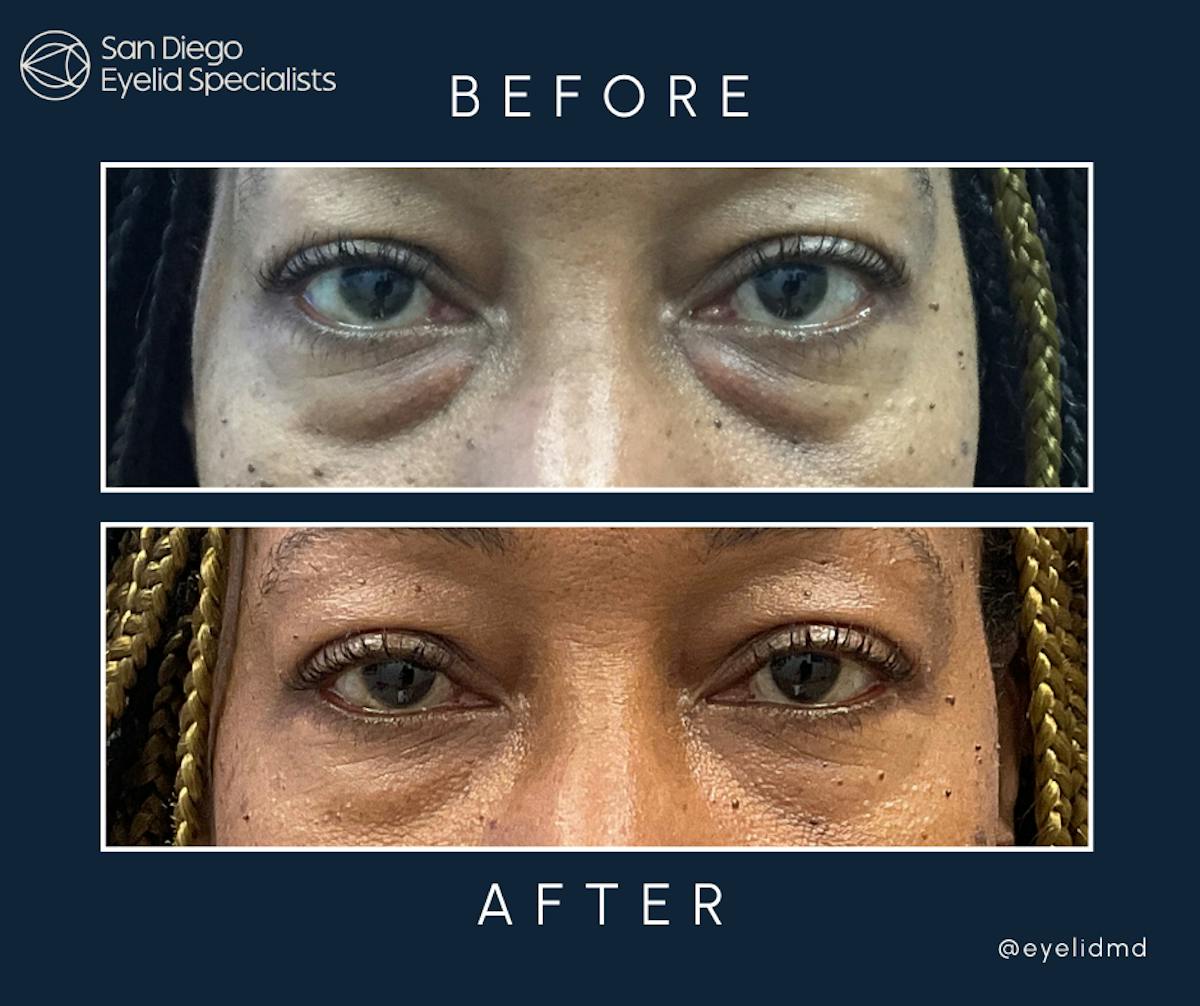 Lower Blepharoplasty Before & After Gallery - Patient 169427 - Image 1