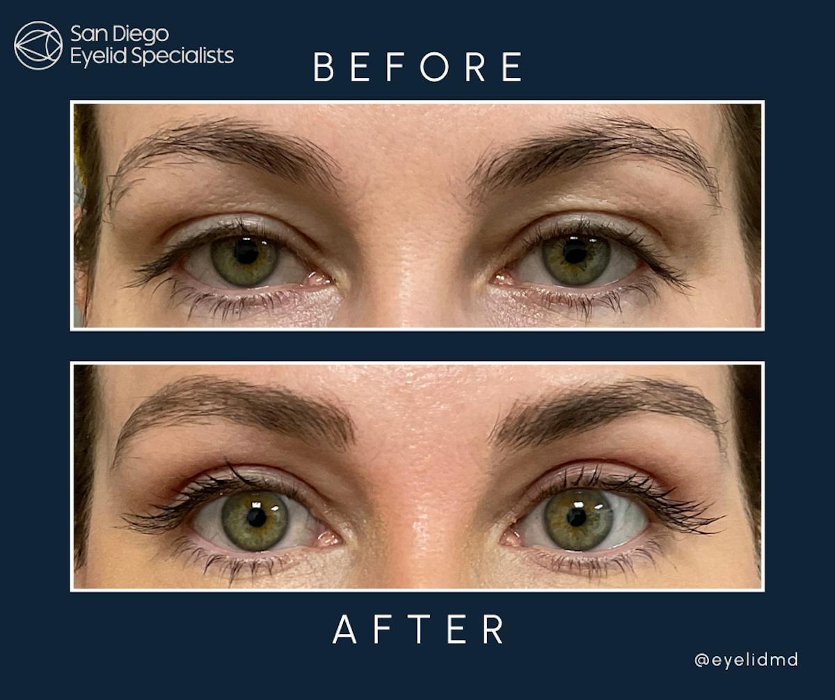 Upper Blepharoplasty Before & After Gallery - Patient 503582 - Image 1