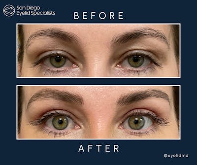 Upper Blepharoplasty Before & After Gallery - Patient 503582 - Image 1