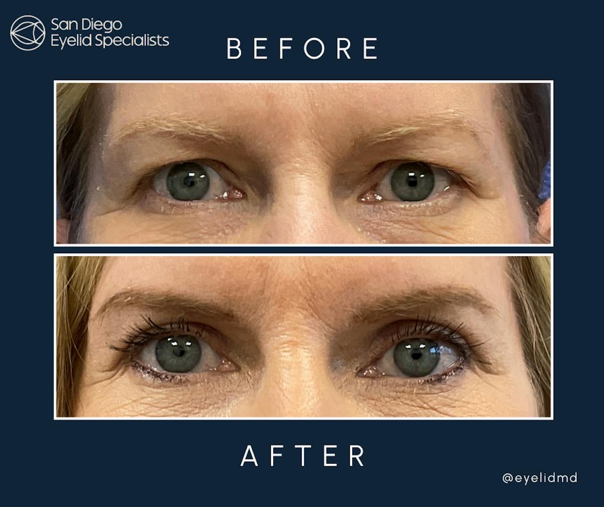 Upper Blepharoplasty Before & After Gallery - Patient 344738 - Image 1