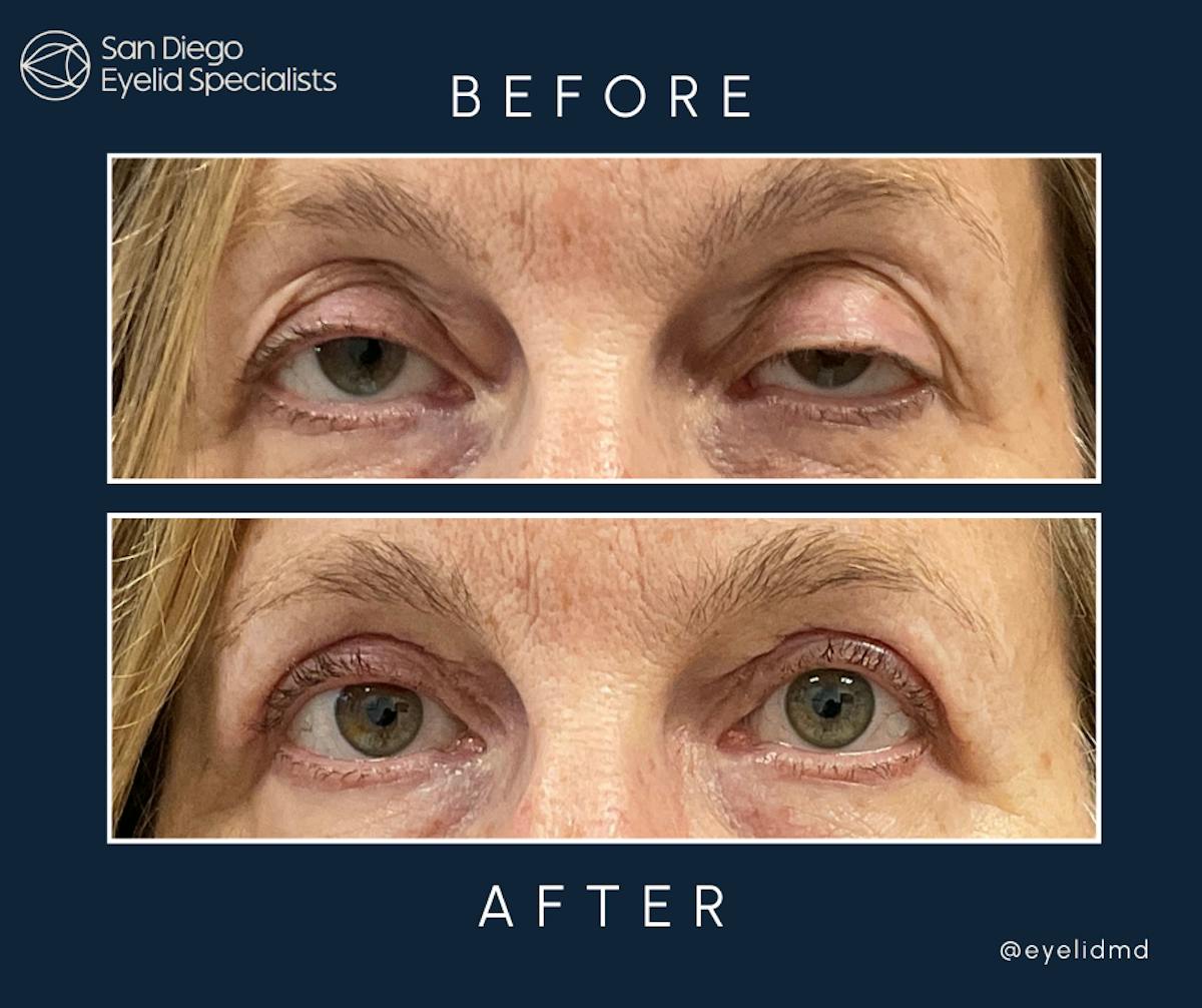 Upper Blepharoplasty Before & After Gallery - Patient 209134 - Image 1