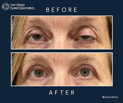 Upper Blepharoplasty Before & After Gallery - Patient 209134 - Image 1