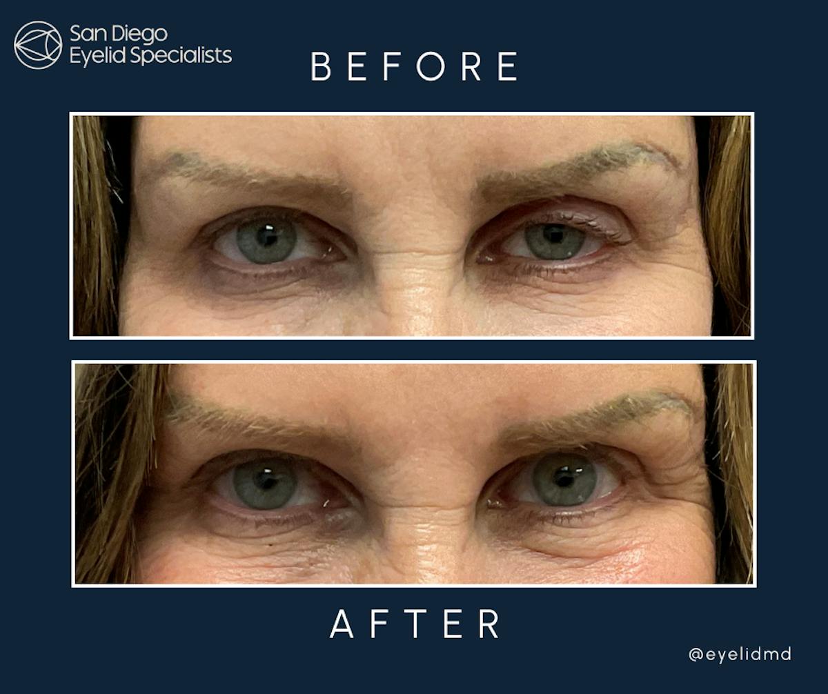 Upper Blepharoplasty Before & After Gallery - Patient 352274 - Image 1