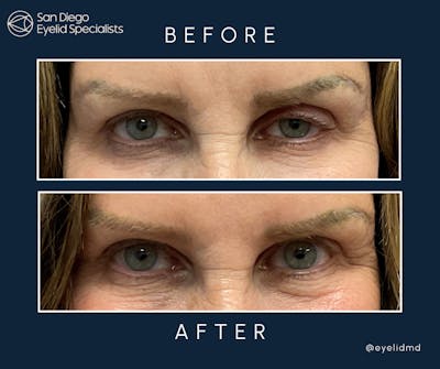 Upper Blepharoplasty Before & After Gallery - Patient 352274 - Image 1