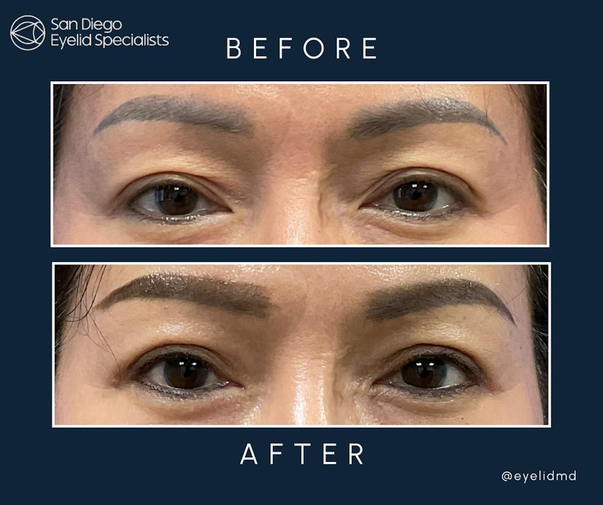 Upper Blepharoplasty Before & After Gallery - Patient 136594 - Image 1