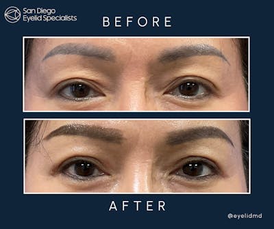 Upper Blepharoplasty Before & After Gallery - Patient 136594 - Image 1