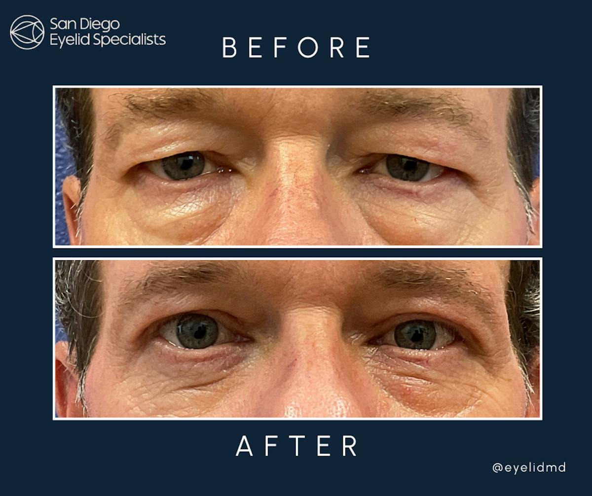 Upper Blepharoplasty Before & After Gallery - Patient 413716 - Image 1
