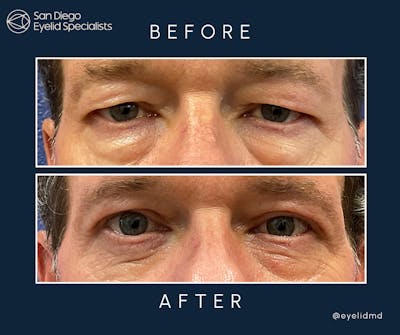 Lower Blepharoplasty Before & After Gallery - Patient 261271 - Image 1