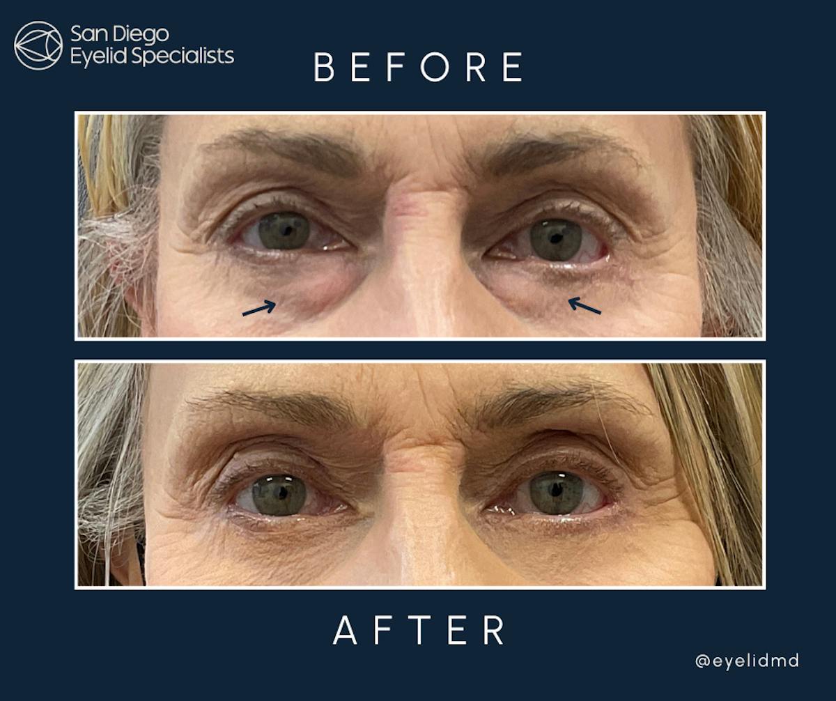 Revision Before & After Gallery - Patient 117140 - Image 1