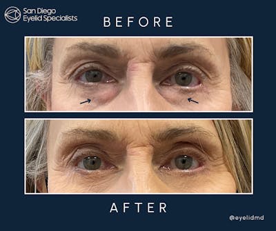 Revision Before & After Gallery - Patient 117140 - Image 1