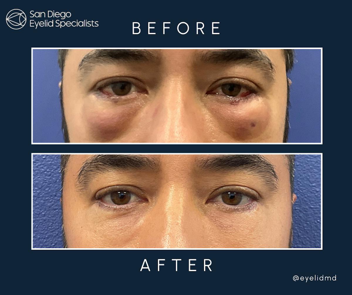 Revision Before & After Gallery - Patient 297085 - Image 1