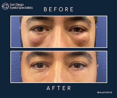 Revision Before & After Gallery - Patient 297085 - Image 1