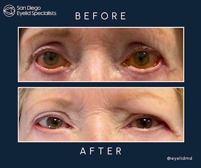 Revision Before & After Gallery - Patient 180005 - Image 1