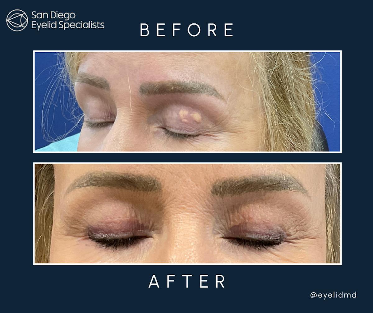 Revision Before & After Gallery - Patient 189383 - Image 1