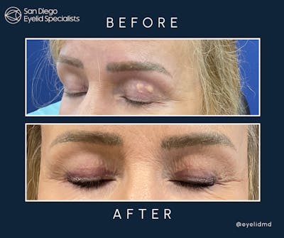 Revision Before & After Gallery - Patient 189383 - Image 1