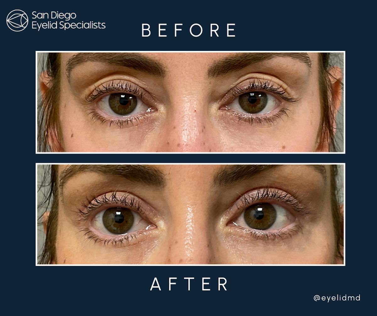 Cosmetic Upper Eyelid Surgery   Before & After Gallery - Patient 413716 - Image 1