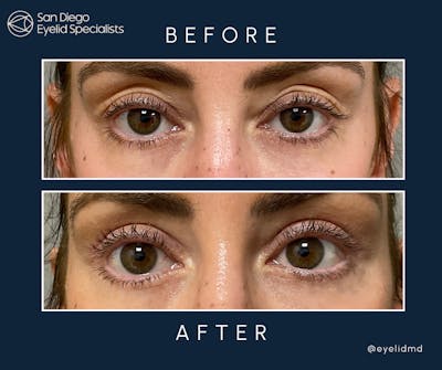 Cosmetic Upper Eyelid Surgery   Before & After Gallery - Patient 413716 - Image 1