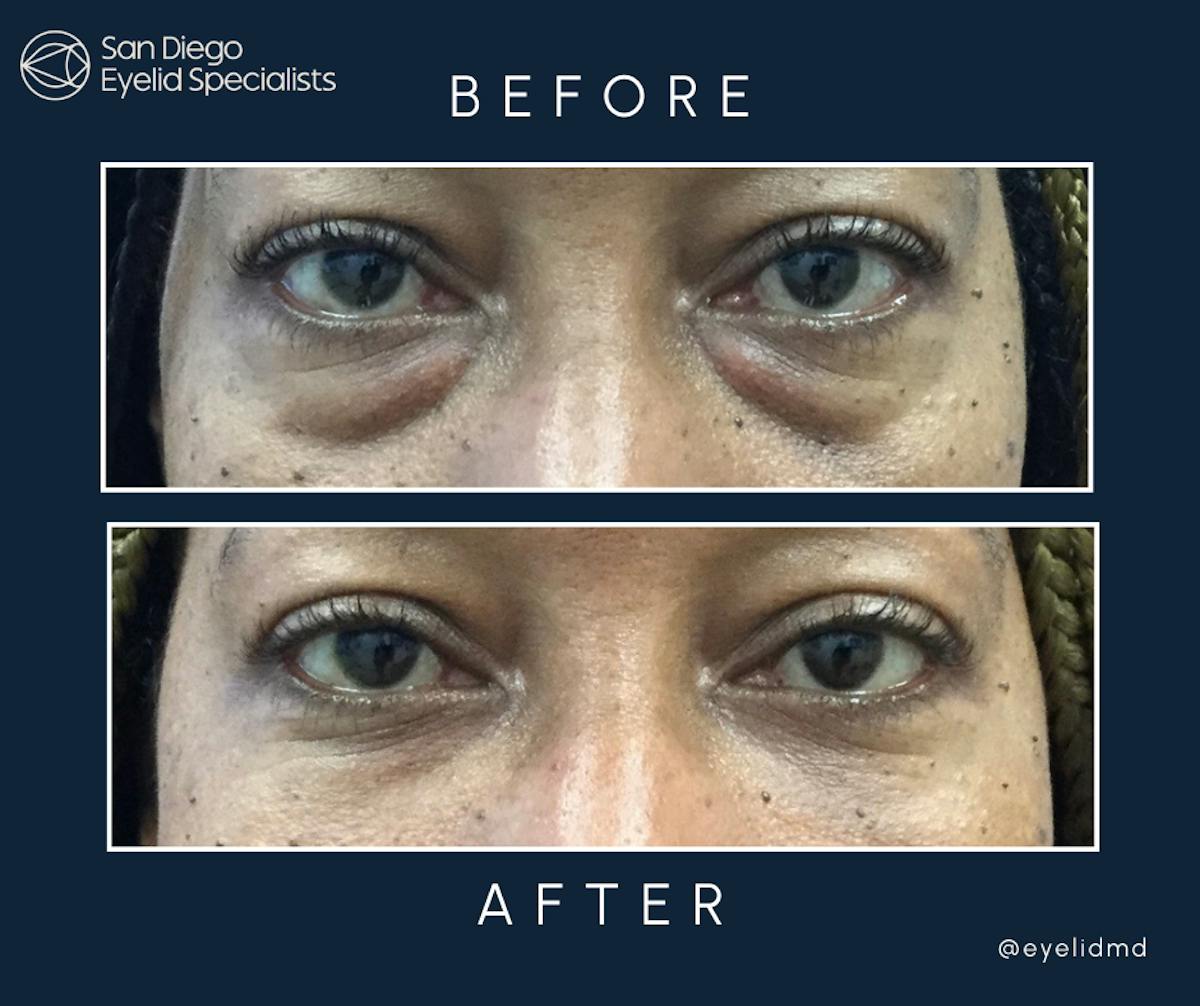 Cosmetic Lower Eyelid Surgery Before & After Gallery - Patient 261271 - Image 1