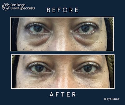 Cosmetic Lower Eyelid Surgery Before & After Gallery - Patient 261271 - Image 1