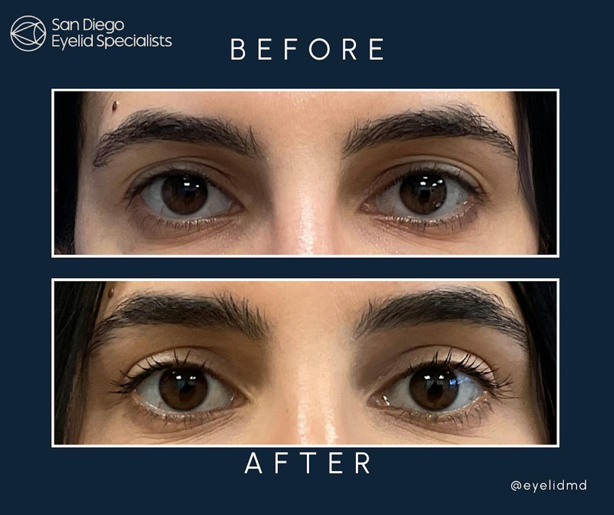 Cosmetic Upper Eyelid Surgery   Before & After Gallery - Patient 831957 - Image 1
