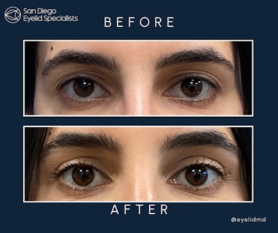 Cosmetic Upper Eyelid Surgery   Before & After Gallery - Patient 831957 - Image 1