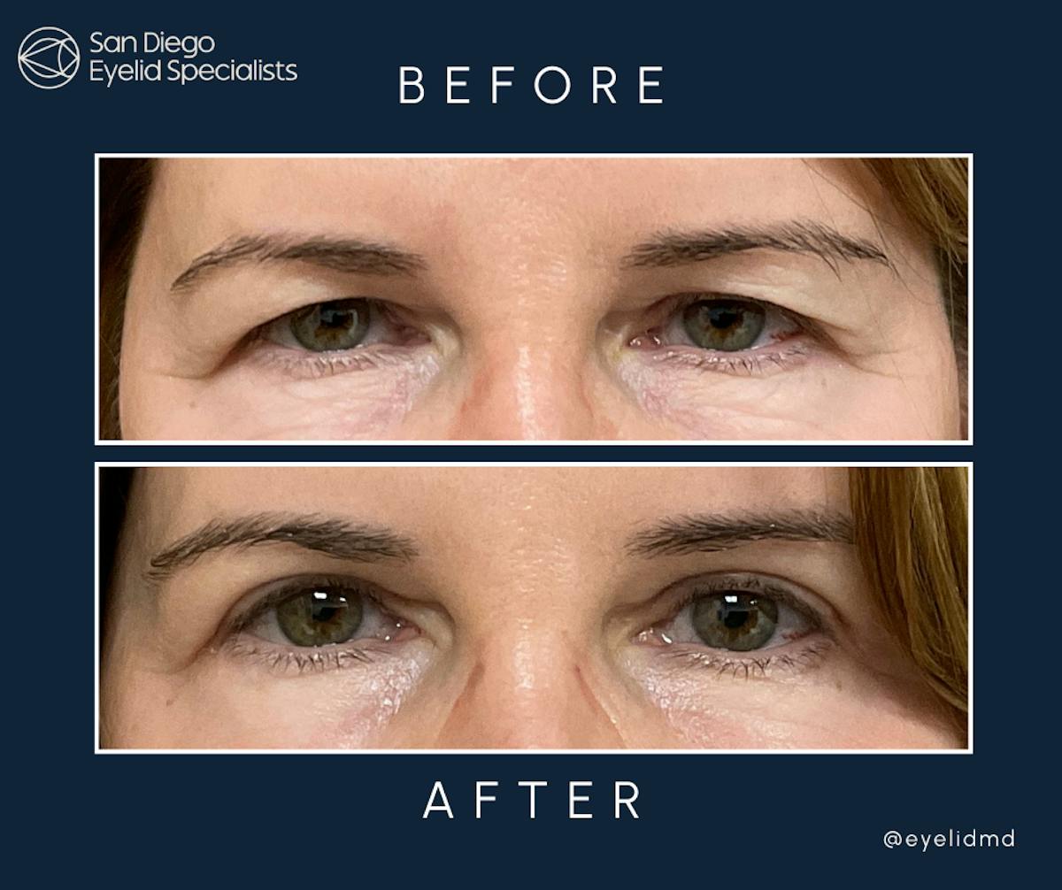 Cosmetic Upper Eyelid Surgery   Before & After Gallery - Patient 979157 - Image 1