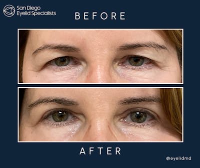 Cosmetic Upper Eyelid Surgery   Before & After Gallery - Patient 979157 - Image 1
