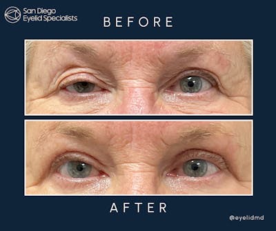 Cosmetic Upper Eyelid Surgery   Before & After Gallery - Patient 182295 - Image 1