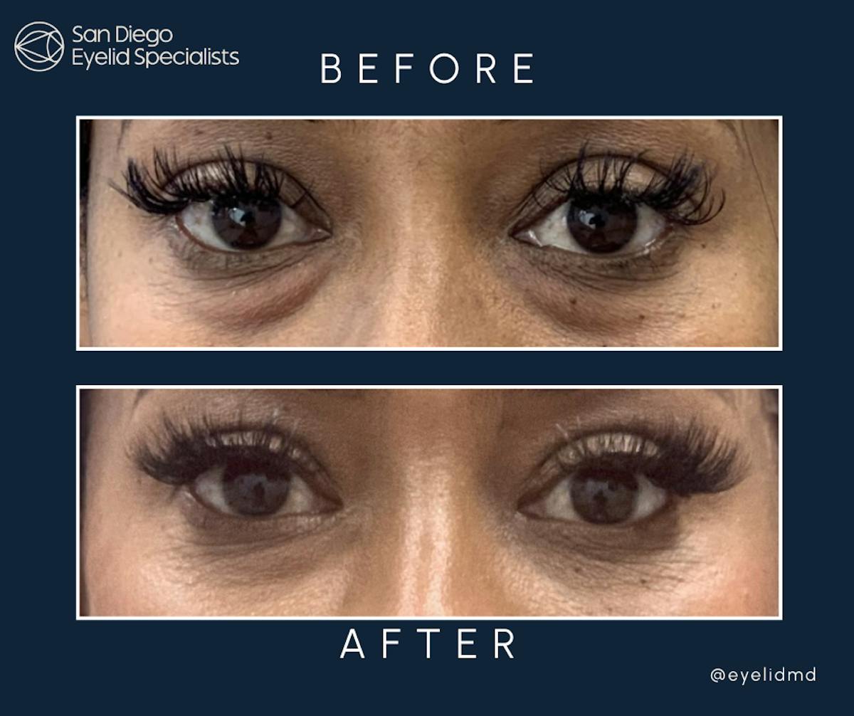 Cosmetic Lower Eyelid Surgery Before & After Gallery - Patient 410550 - Image 1