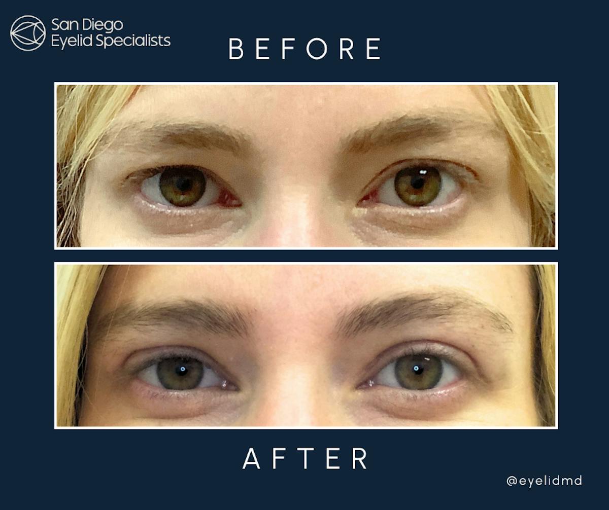 Cosmetic Upper Eyelid Surgery   Before & After Gallery - Patient 190882 - Image 1
