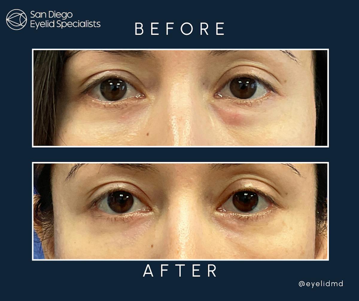 Revisional Eyelid Surgery     Before & After Gallery - Patient 420100 - Image 1