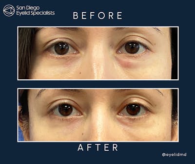 Revisional Eyelid Surgery Before & After Gallery - Patient 420100 - Image 1