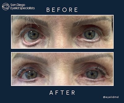 Revisional Eyelid Surgery Before & After Gallery - Patient 300125 - Image 1
