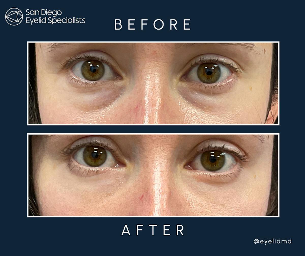 Cosmetic Lower Eyelid Surgery Before & After Gallery - Patient 345920 - Image 1