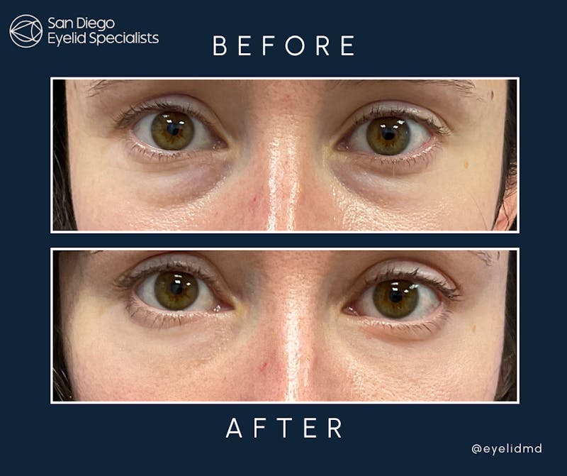 Cosmetic Lower Eyelid Surgery Before & After Gallery - Patient 345920 - Image 1