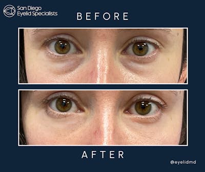 Cosmetic Lower Eyelid Surgery Before & After Gallery - Patient 345920 - Image 1