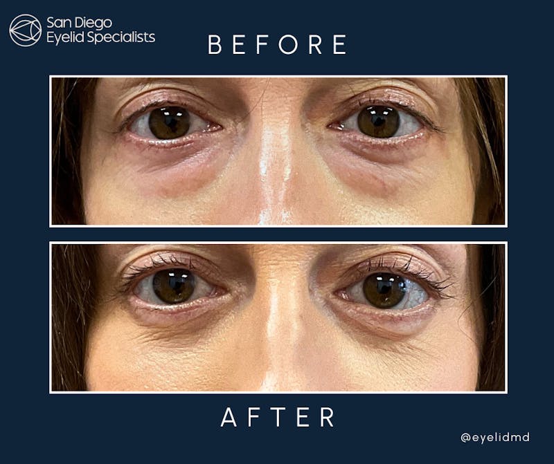 Cosmetic Lower Eyelid Surgery Before & After Gallery - Patient 418075 - Image 1
