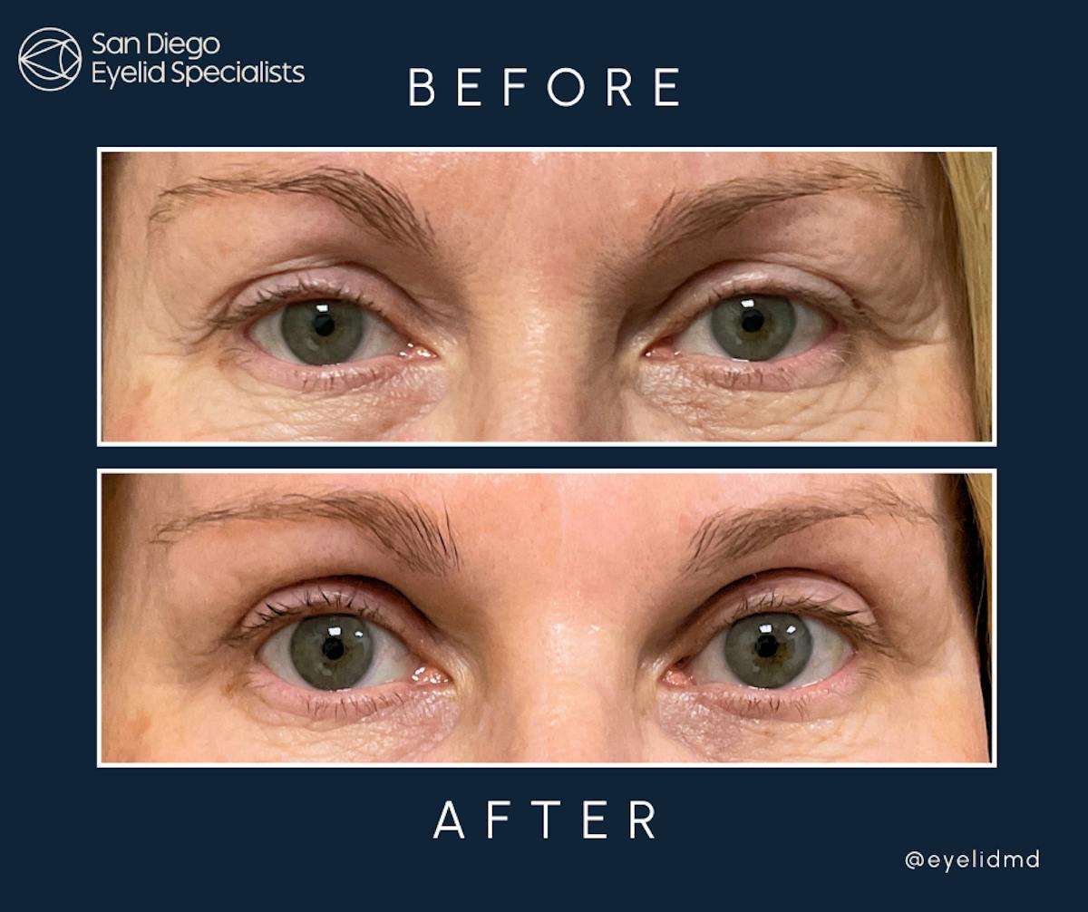 Cosmetic Upper Eyelid Surgery   Before & After Gallery - Patient 262356 - Image 1