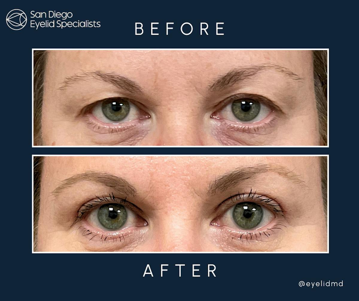 Cosmetic Upper Eyelid Surgery Before & After Gallery - Patient 320750 - Image 1