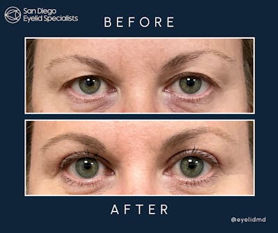 Cosmetic Upper Eyelid Surgery Before & After Gallery - Patient 320750 - Image 1