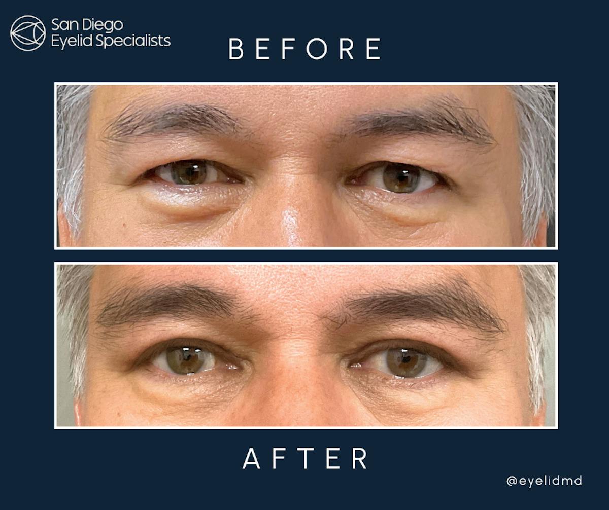 Cosmetic Upper Eyelid Surgery   Before & After Gallery - Patient 504562 - Image 1